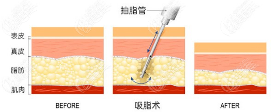 抽脂手术示意图