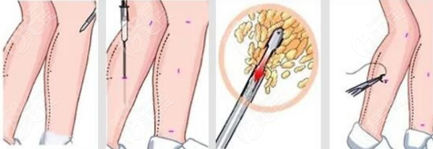 抽脂手术示意图