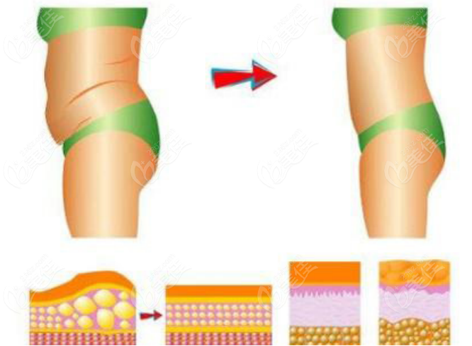 抽脂手术示意图