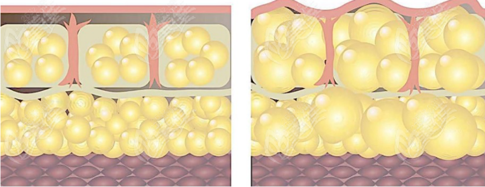 抽脂手术示意图