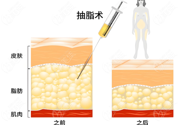抽脂前后对比
