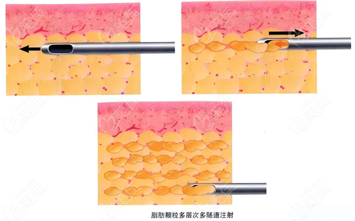 脂肪注射技术