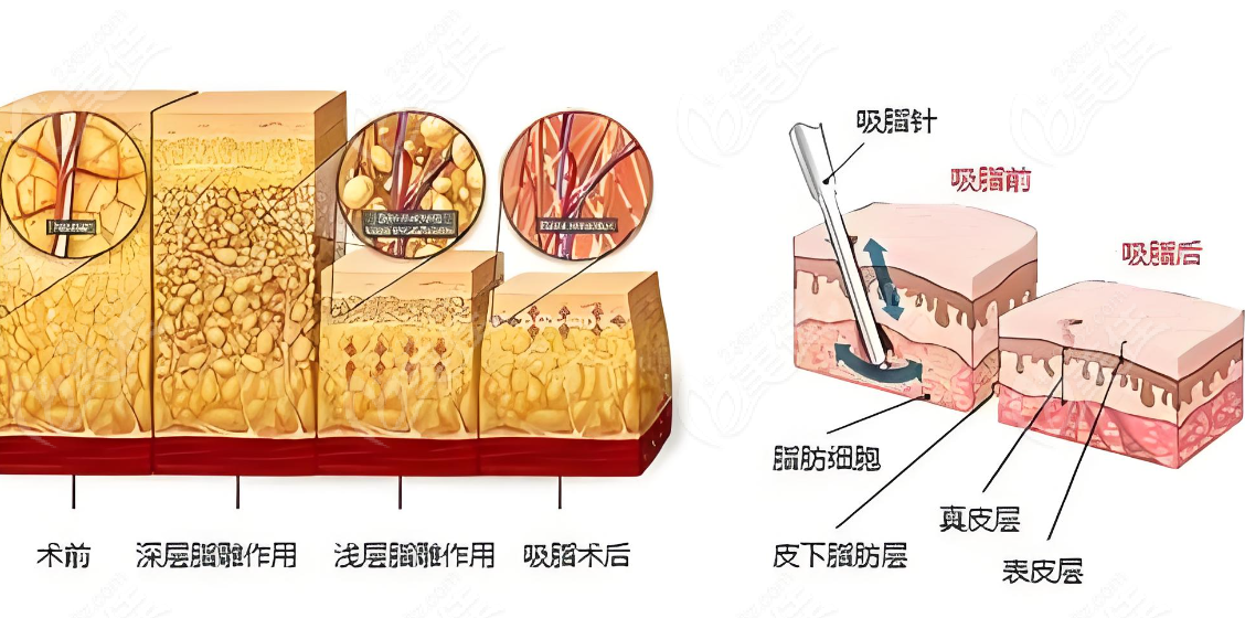 吸脂前后对比