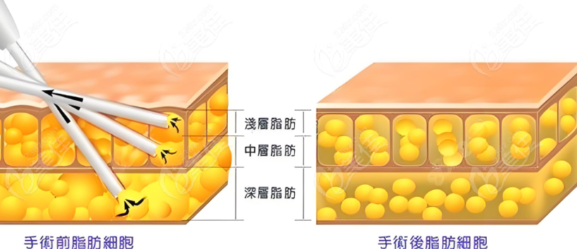 手术前后吸脂细胞对比