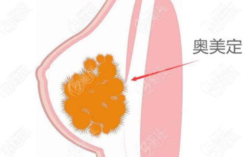 236z.com异物取出手术示意图