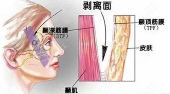 面部筋膜悬吊术手术过程是怎样做的