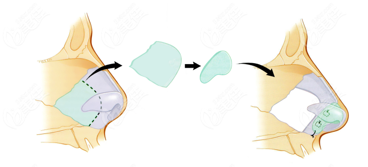 韩国sharp整形外科隆鼻手术