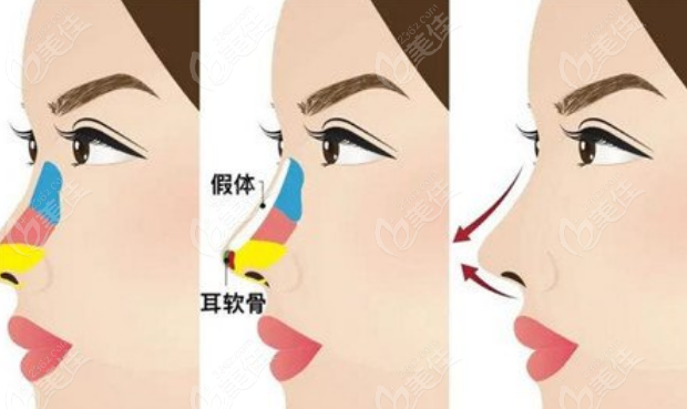 杭州艺星整形张龙隆鼻有超多实例