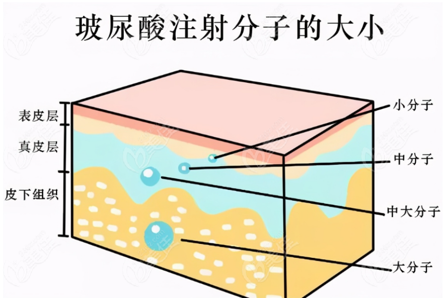 玻尿酸注射手术