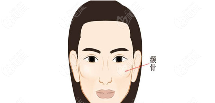 何照华做颧骨整形价格表