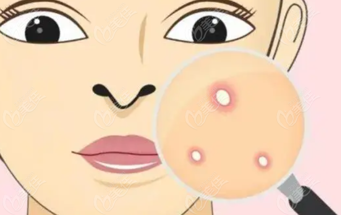 韩国祝福皮肤科祛痘好不好？好