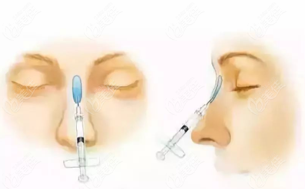 愛貝芙注射隆鼻多久定型