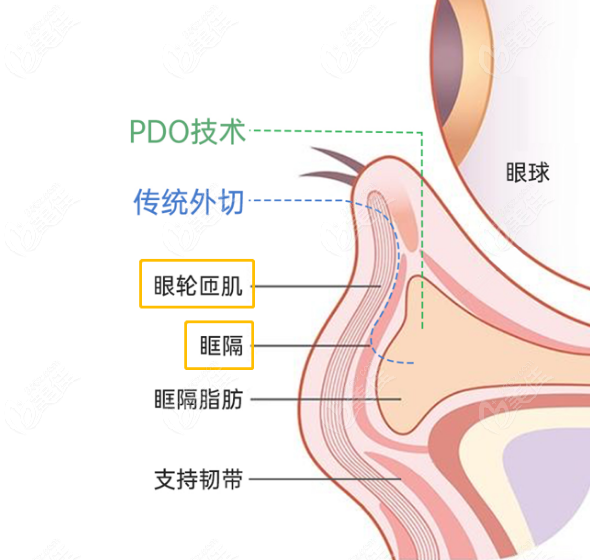 重庆华美谷琪医生去眼袋手术优势