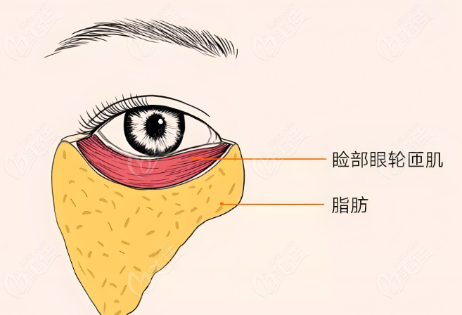 魏志香内眼角修复会修复受损的眼轮匝肌吗？