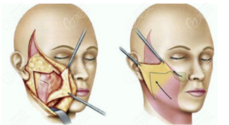 面部提升手术示意图