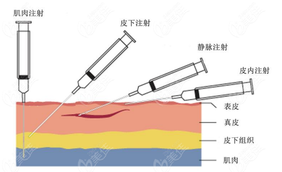 玻尿酸注射手术