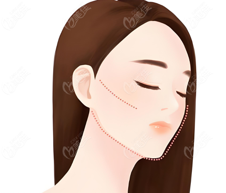 耳基底提升是局部提升,适合轻中度松弛情况