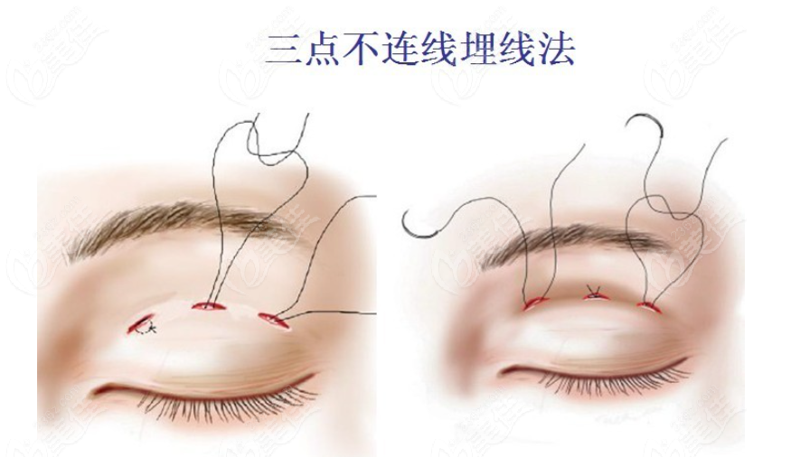 北京美和眼科的小瞼裂手術