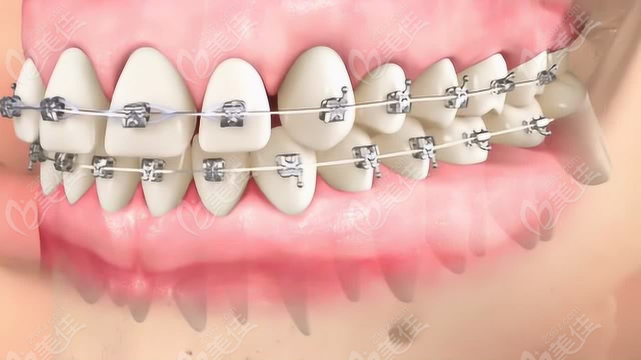 牙齿矫正结构示意图