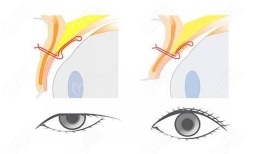 北京美和上睑下垂矫正技术特点