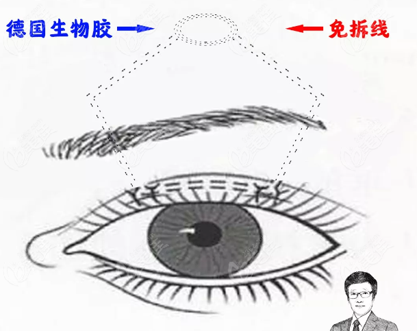 于剛眼瞼下垂免拆線