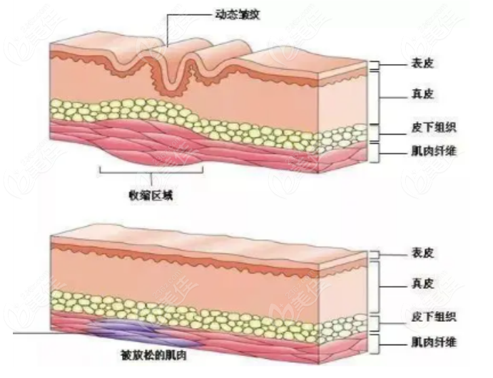 注射玻尿酸