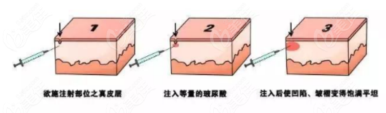 236z.com注射玻尿酸