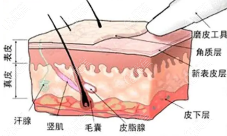 北京广济医院疤痕科注射示意图