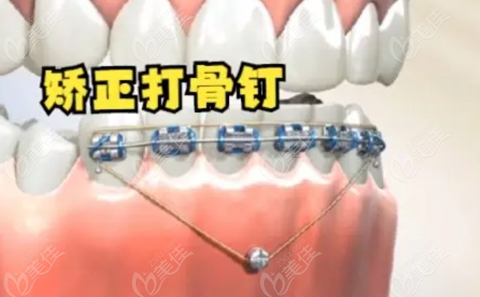 牙齿矫正过程中打骨钉