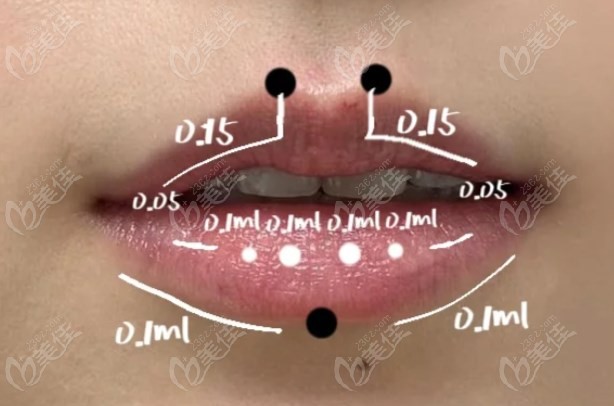 唇部填充玻尿酸几ml