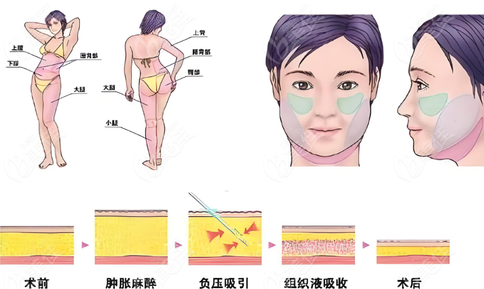 吸脂手術(shù)