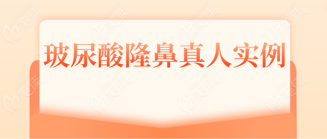 玻尿酸隆鼻真人實例分享
