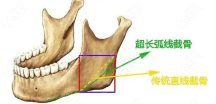 236z.com下颌角手术示意图