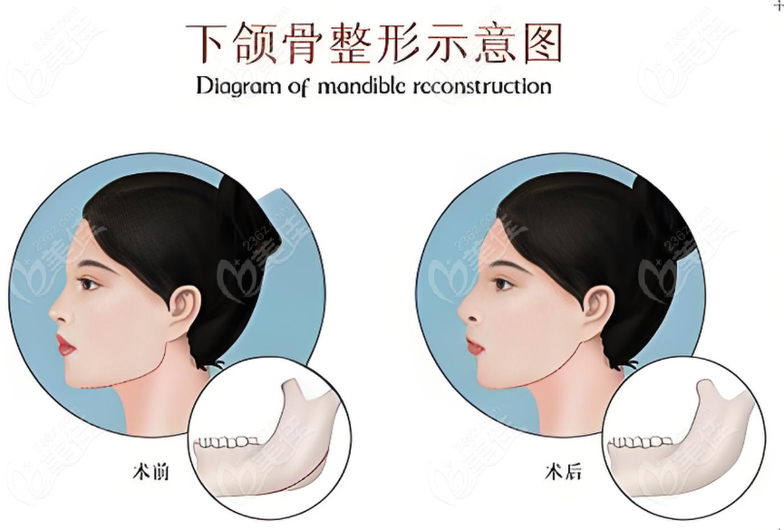 下巴U型截骨手术
