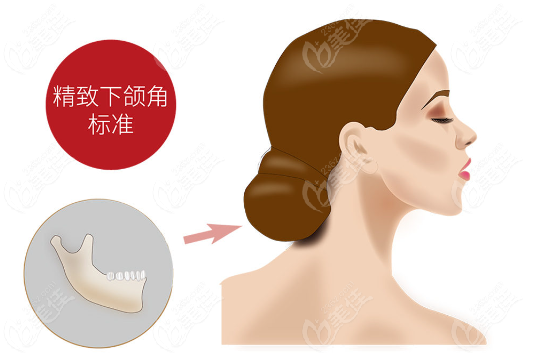 下巴U型截骨多少钱？