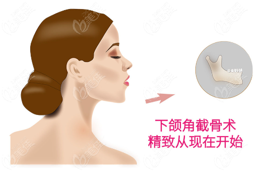 下巴U型截骨整容大变脸www.236z.com