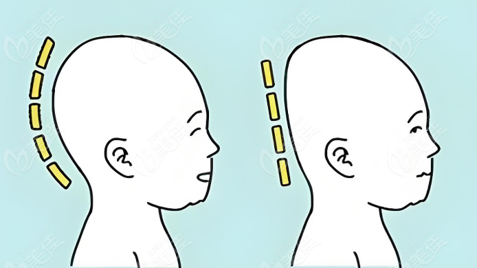 韩国后脑勺整形正规医院雕刻整形真实实例