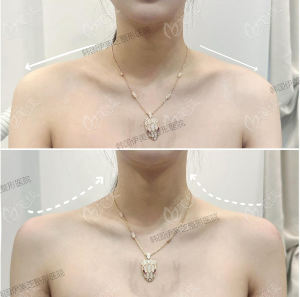 韓國伊美芝整形注射直角肩實例對比圖分享