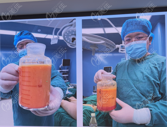 冯牧夷医生吸脂在重庆排名前三