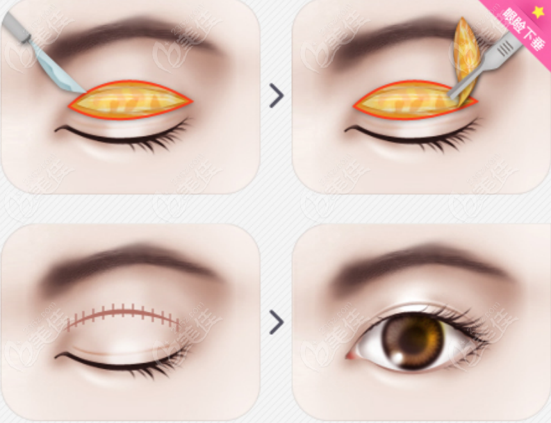 双眼皮手术示意图