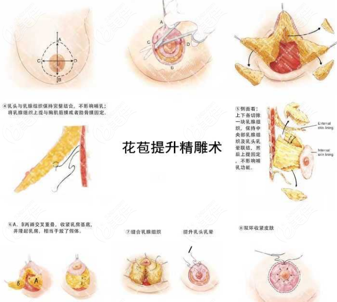 深圳劉富增主做花苞提升術(shù)