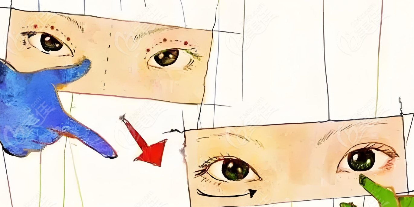 劉志剛雙眼皮修復(fù)真實(shí)反饋 劉志剛雙眼皮修復(fù)真實(shí)反饋