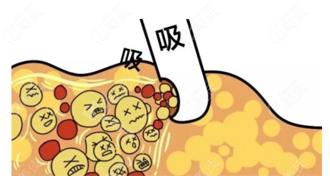 杭州冯志丹抽脂失败修复实例分享