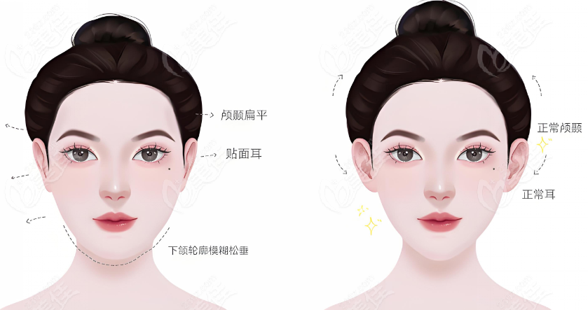 macs轮廓修复一般要花多少钱？