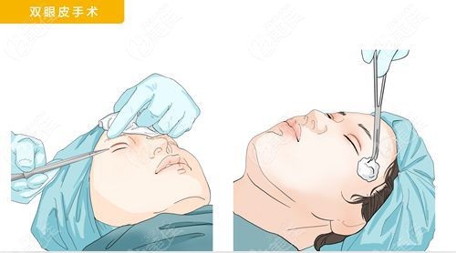 南医大友谊医院双眼皮手术多少钱？金东勋做双眼皮+开眼角16800元起，活动价快抢