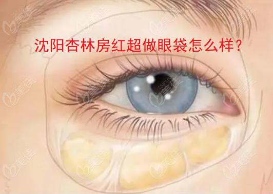 沈陽杏林房紅超做眼袋怎么樣