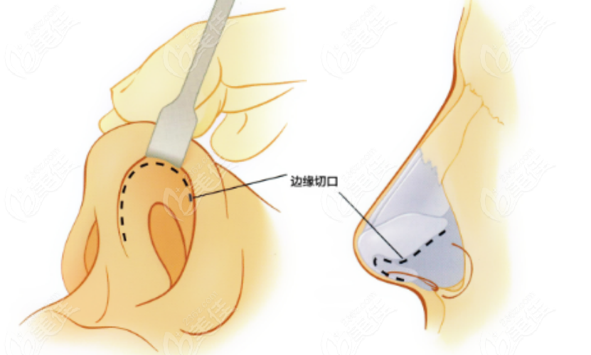 隆鼻手术示意图