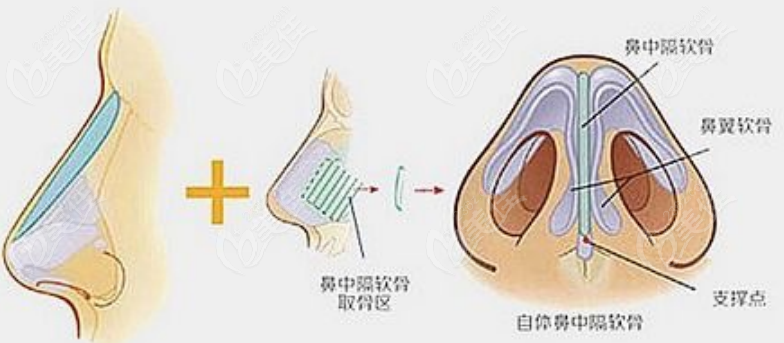 隆鼻手术示意图