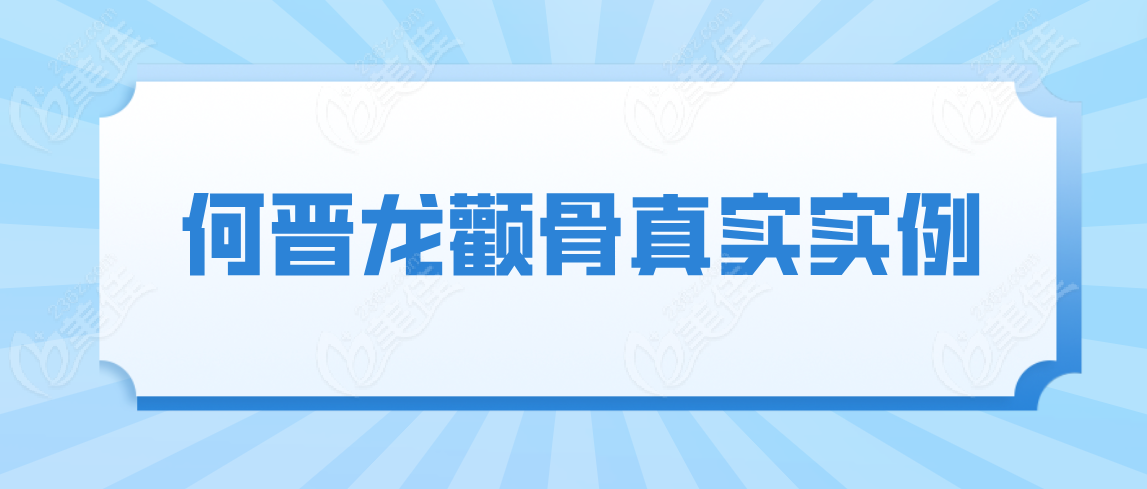 何晋龙颧骨真实实例