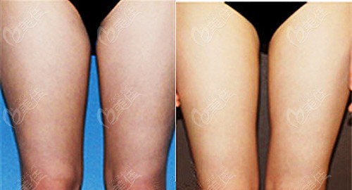 韩国MIDAS整形外科吸脂实例 韩国MIDAS整形外科吸脂实例